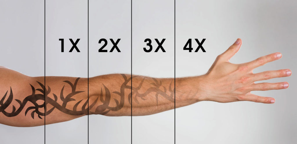 Avant-bras tatoué s'estompant progressivement après 1, 2, 3 puis 4 séances de laser PicoWay